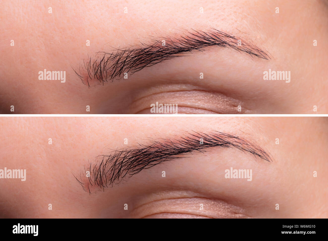 Before And After Endoscopic Eyebrow Lifting Procedure Stock Photo