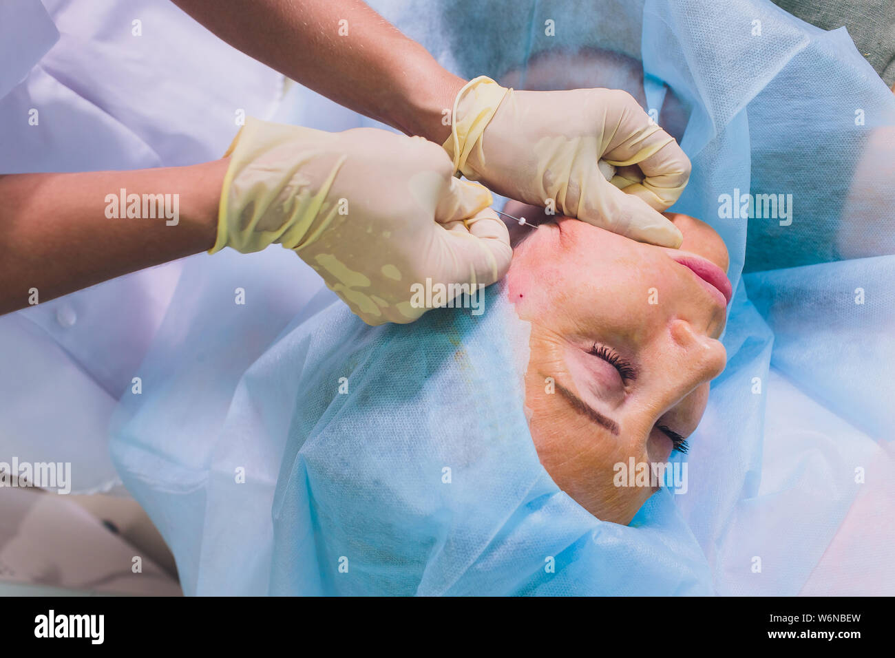 Aged woman doing mesothreads and Thread Lifting, Cosmetology. Cosmetic