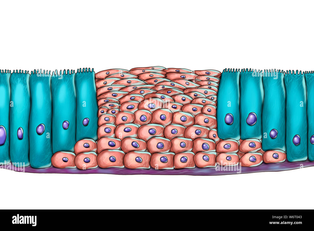 Epithelial metaplasia, computer illustration. Metaplasia is a change of