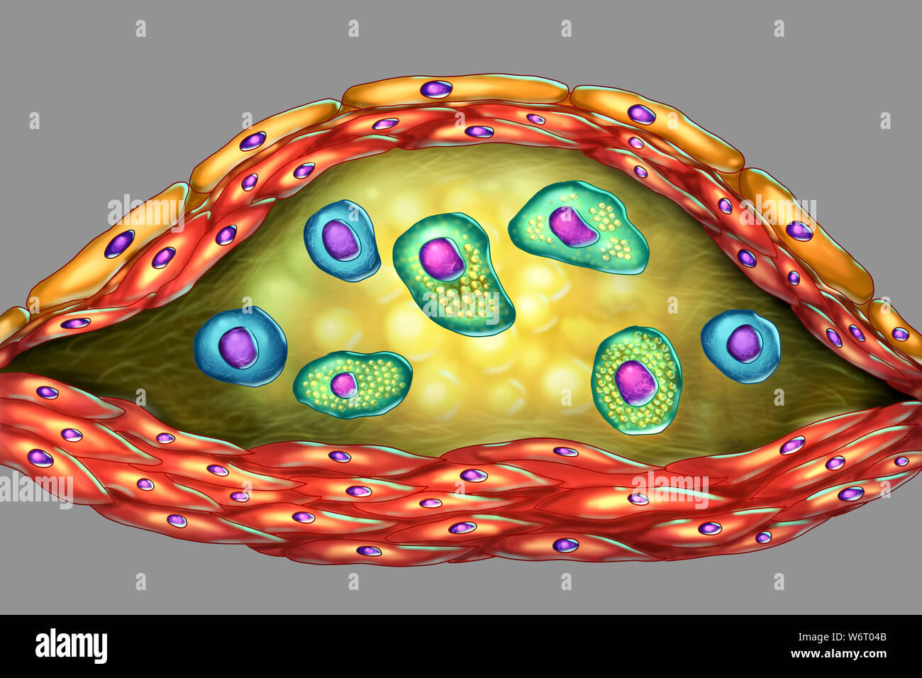 Structure of atherosclerotic plaque, computer illustration. The necrotic centre, foam cells and T-lymphocytes are seen inside of the cholesterol plaque. The walls are made of smooth muscle cells and endothelium from the blood vessel. Stock Photo