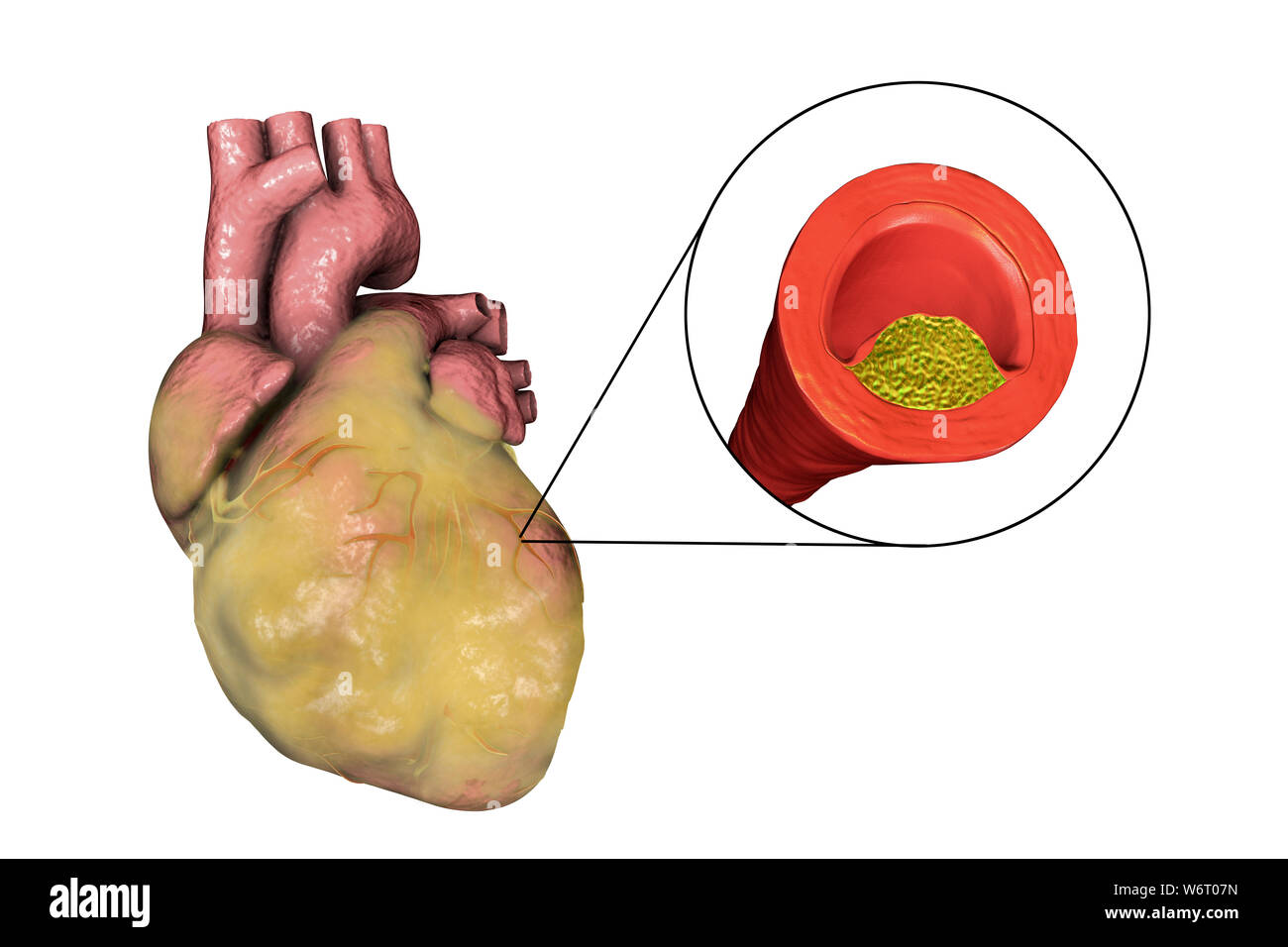 Computer illustration of a fatty heart and a coronary artery narrowed by a fatty plaque. Stock Photo