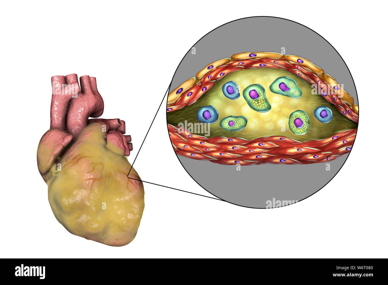 Heart disease, computer illustration. Diseased fatty heart and cross-section of an atherosclerotic plaque and its histological structure, such as necrotic centre, foam cells and T-lymphocytes. Its walls are made of smooth muscle cells and endothelium from the blood vessel. Stock Photo