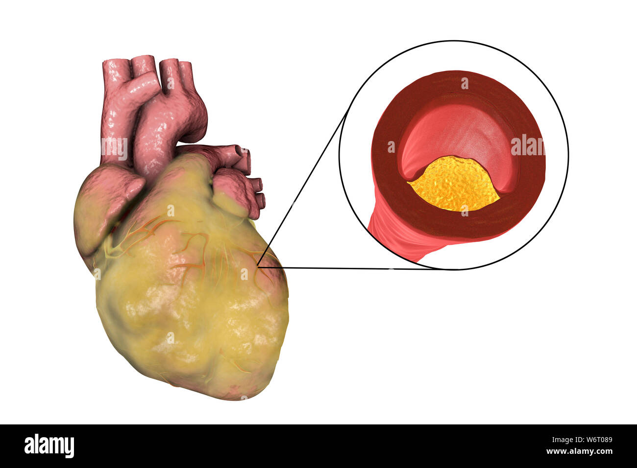 Heart in a mousetrap, Conceptual image on cardiovascular dis