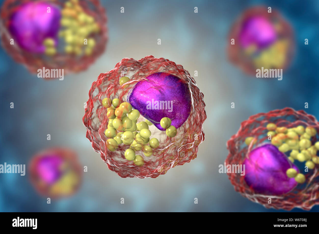Macrophage foam cell, illustration. Foam cells are macrophage cells