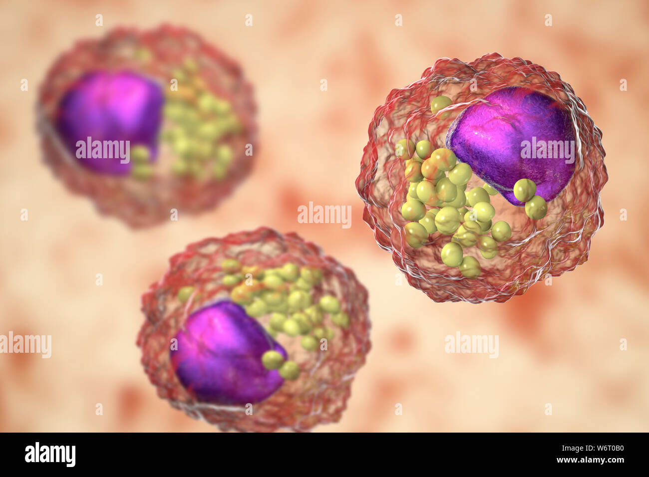 Macrophage foam cell, illustration. Foam cells are macrophage cells that contain lipid droplets and are components of atherosclerotic plaque. Stock Photo