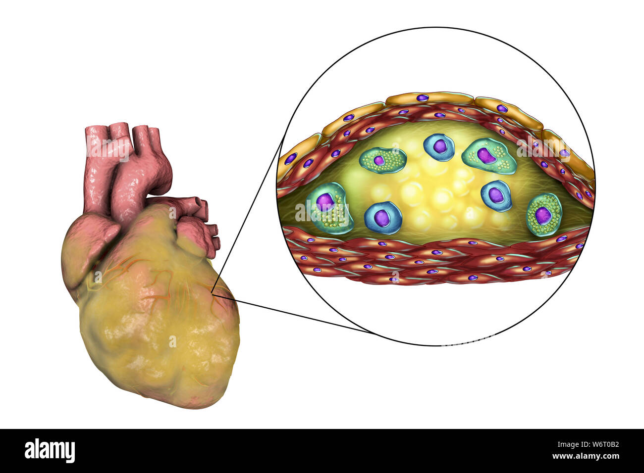 Heart disease, computer illustration. Diseased fatty heart and cross-section of an atherosclerotic plaque and its histological structure, such as necrotic centre, foam cells and T-lymphocytes. Its walls are made of smooth muscle cells and endothelium from the blood vessel. Stock Photo