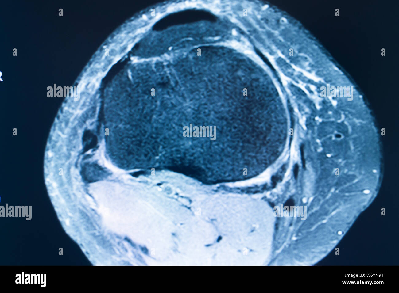Knee sports injury mri mcl grade 2 tear resonance imaging
