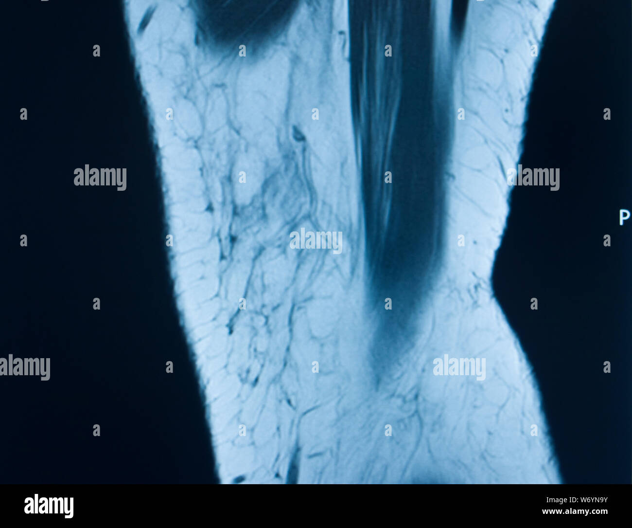 Knee sports injury mri mcl grade 2 tear magnetic resonance imaging ...