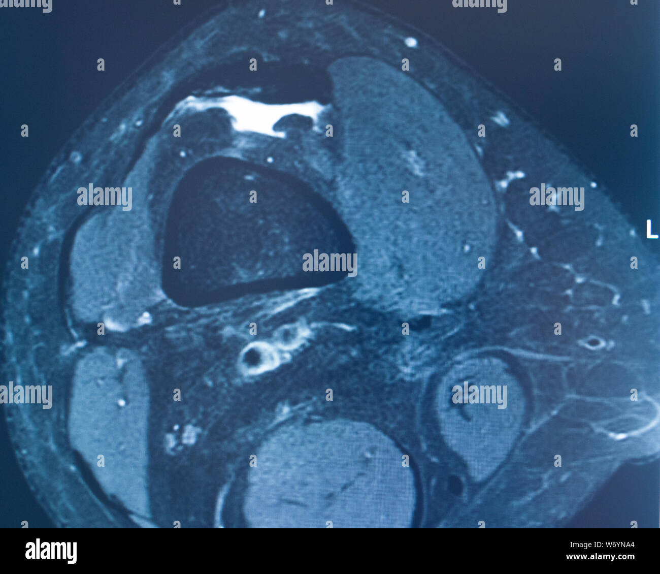 Knee sports injury mri mcl grade 2 tear resonance imaging