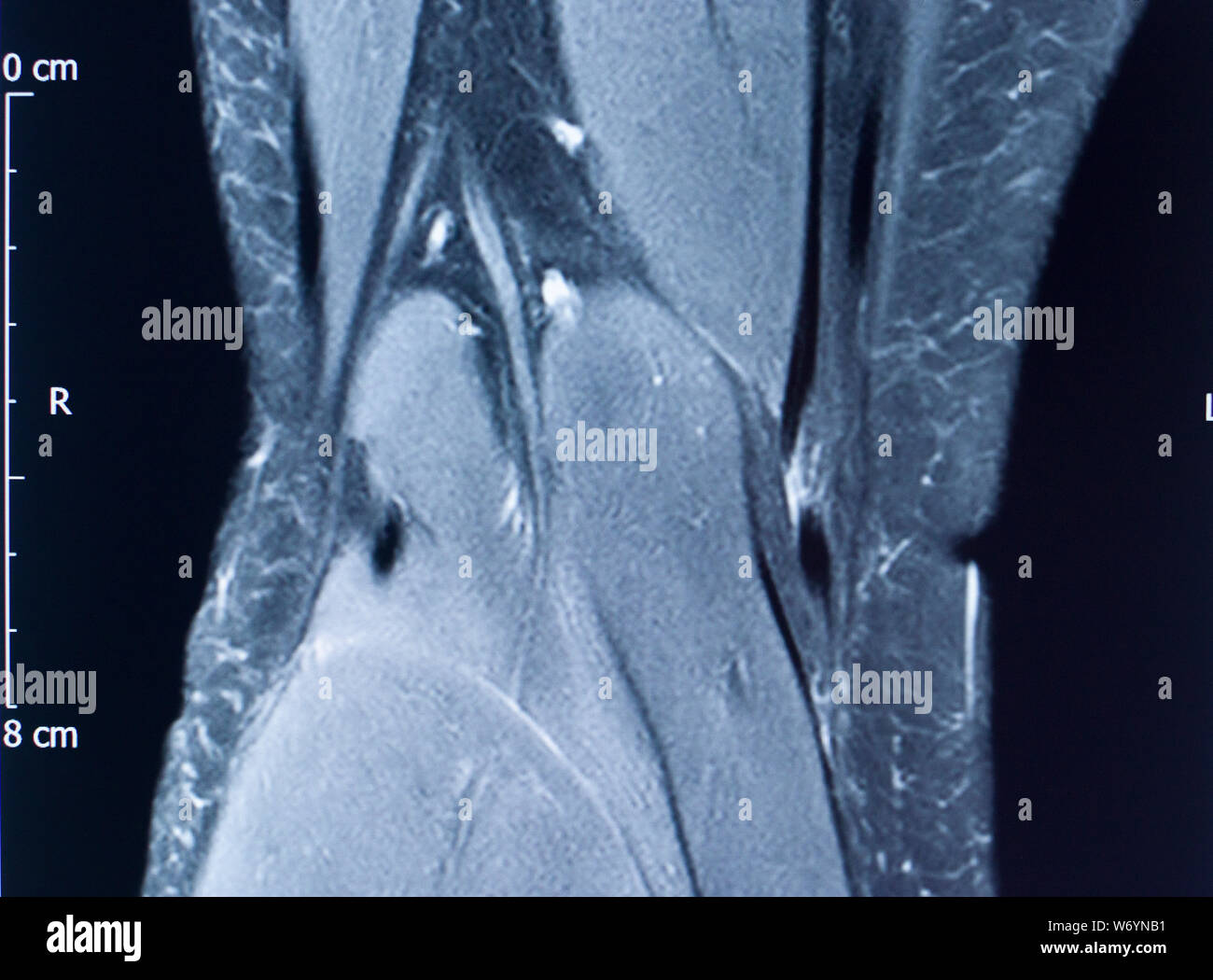 Knee sports injury mri mcl grade 2 tear resonance imaging