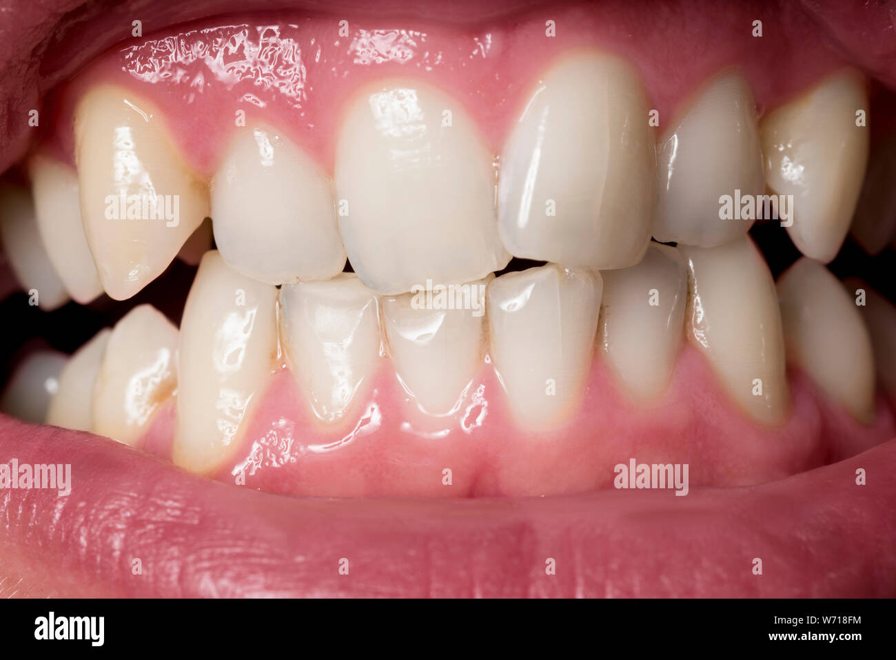 Close up shot of human uneven teeth with some tartar Stock Photo Alamy