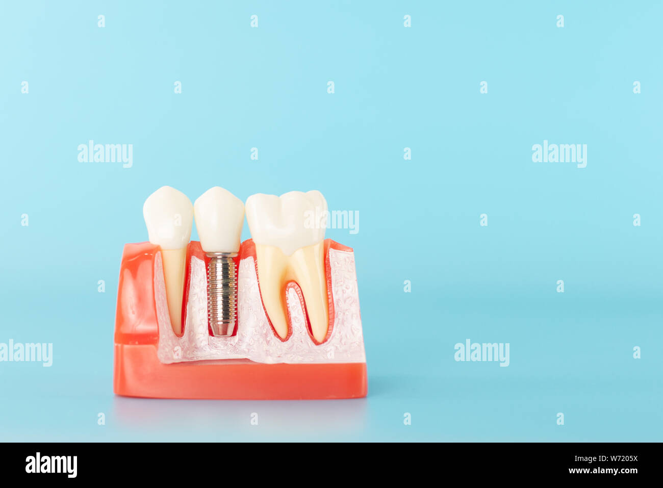 Dental implant model on blue background. Stock Photo