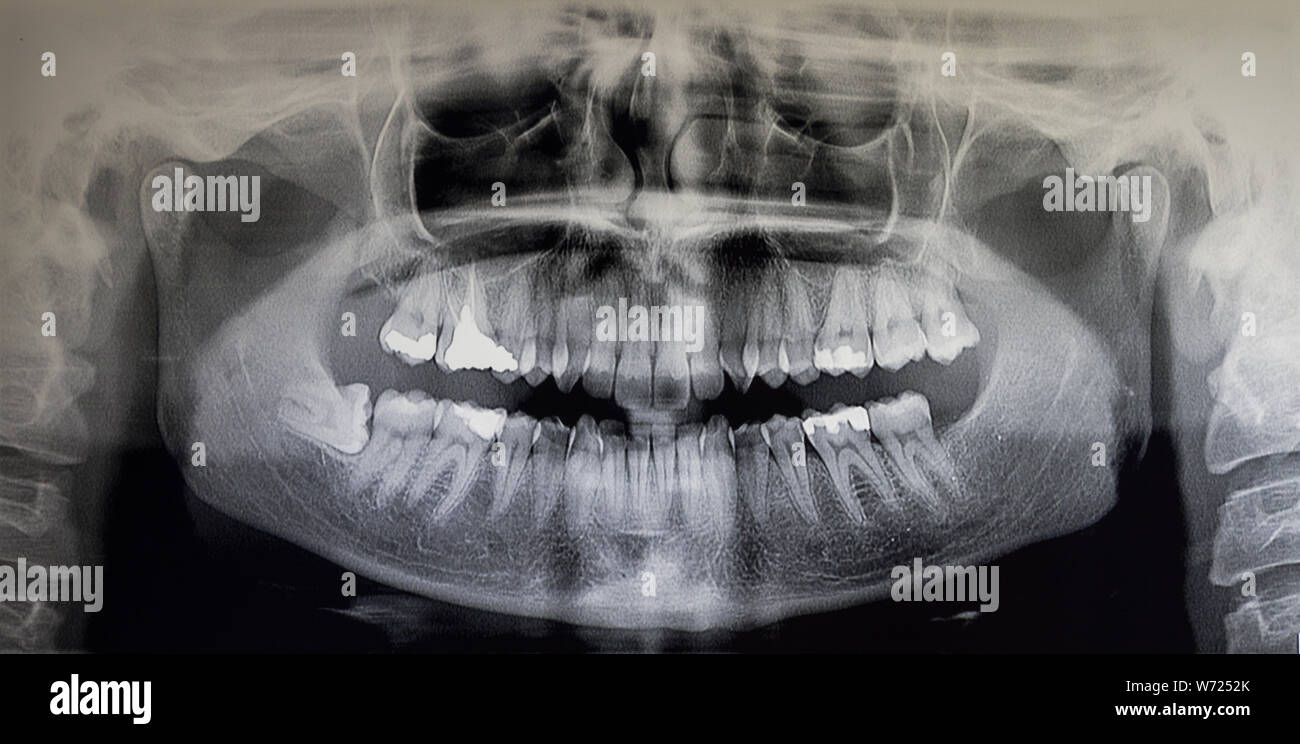 Ortopantomography Orthopantomography of an adult patient Stock Photo - Alamy