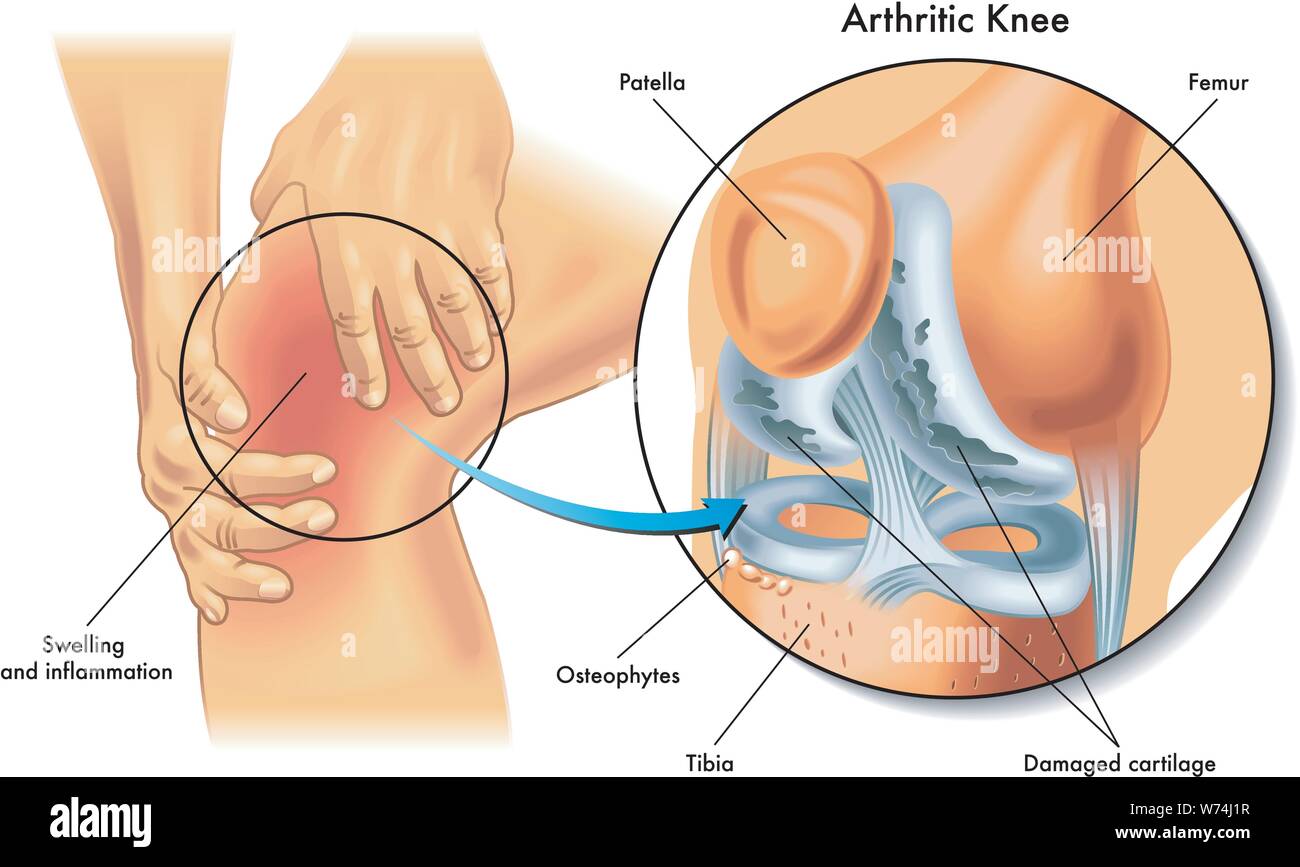 Medical illustration of the symptoms of arthritic knee Stock Vector