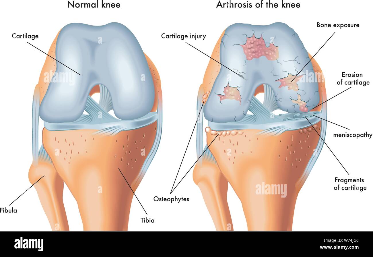 Medical illustration of the symptoms of arthrosis of the knee Stock Vector