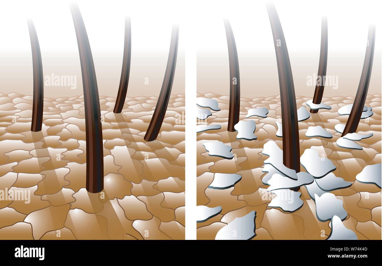 Medical illustration of the symptoms of dandruff on the scalp Stock Vector