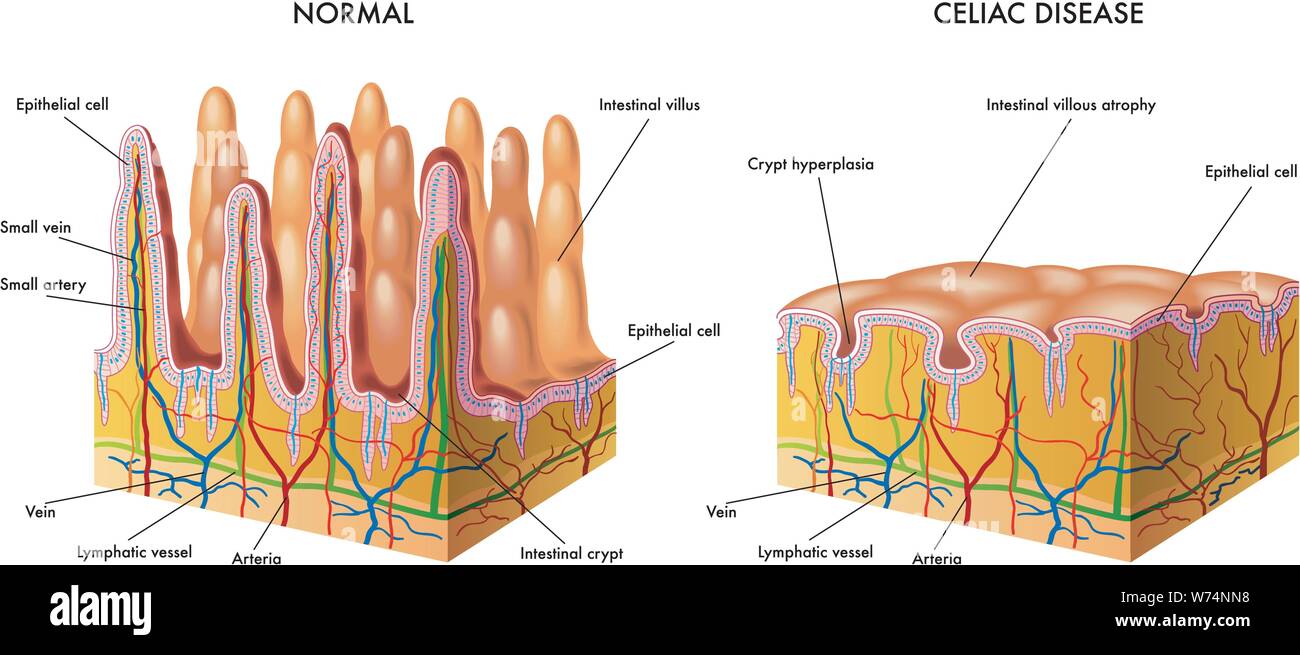 Medical illustration of the modification of the intestinal mucosa in celiac subject Stock Vector