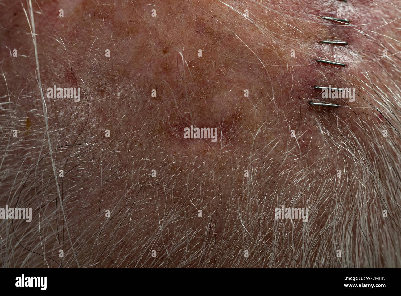 View of 65 year old male's scalp with squamous cell carcinoma site (horizontal) at center along hairline. Site is approx 3/4' across, 1/4' high. Stock Photo