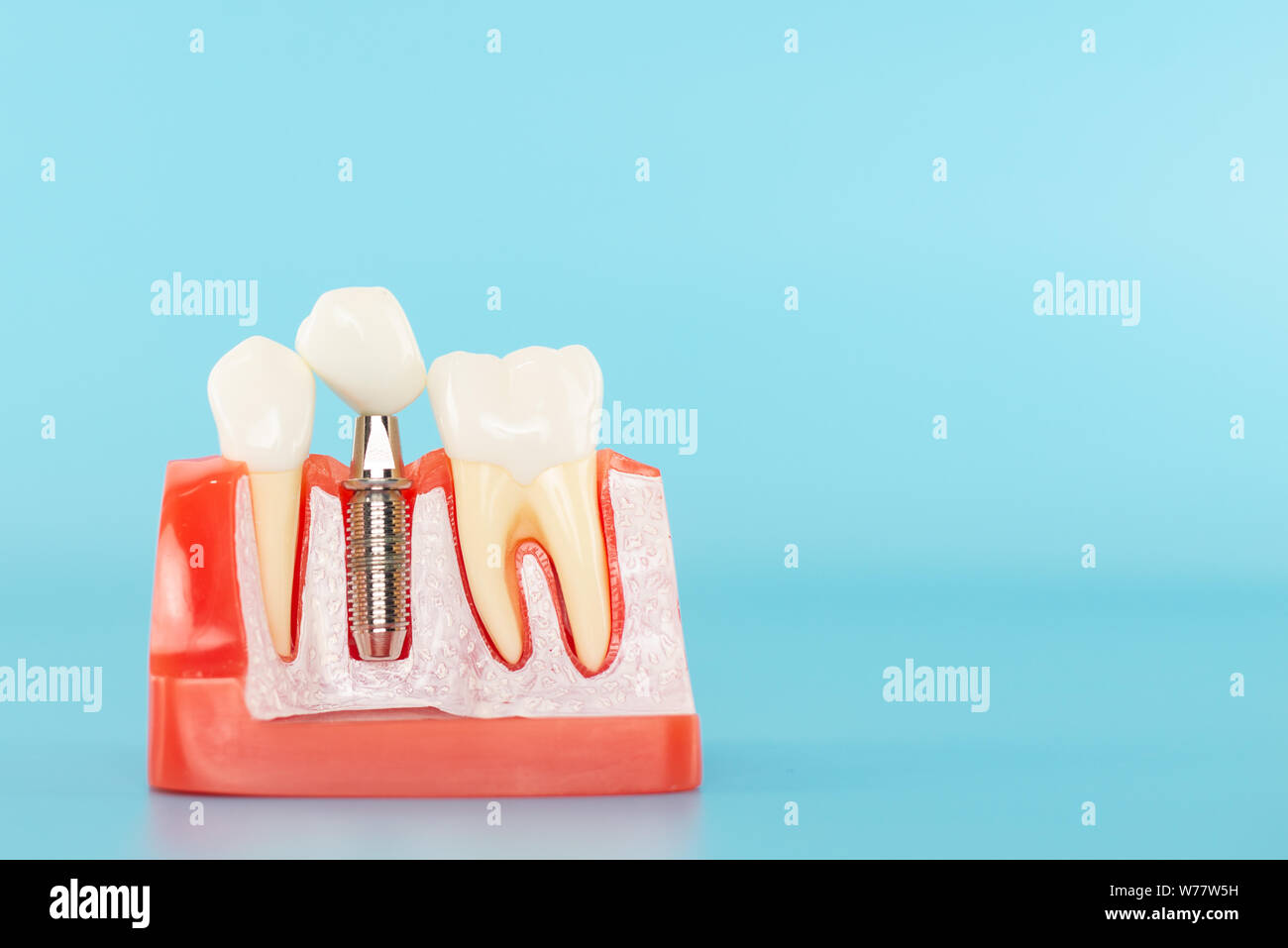 Dental implant model on blue background Stock Photo - Alamy
