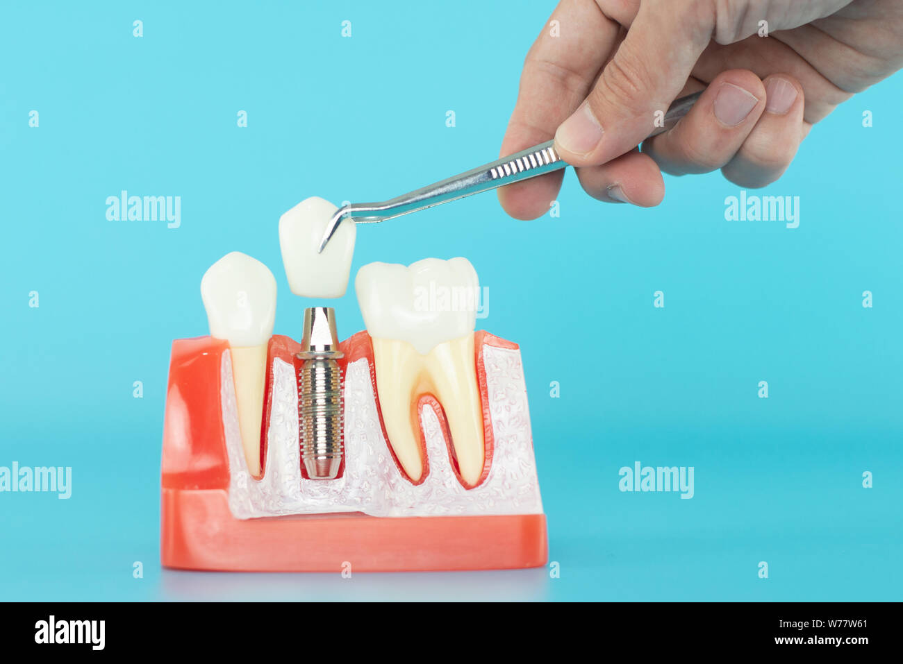 Dental implant model on blue background Stock Photo - Alamy