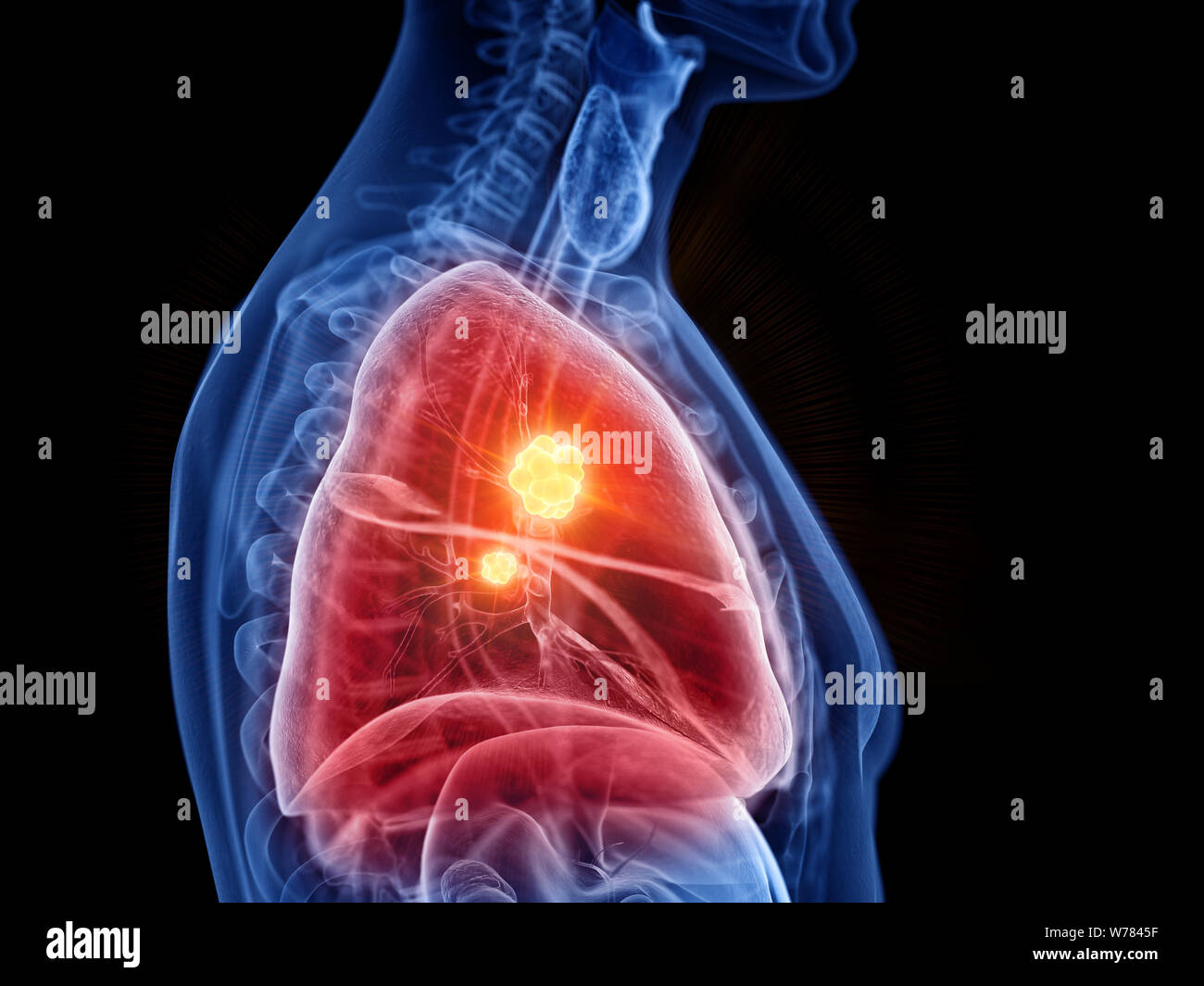 3d rendered medically accurate illustration of lung cancer Stock Photo