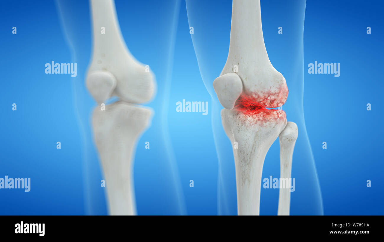 3d rendered medically accurate illustration of an arthritic knee joint ...