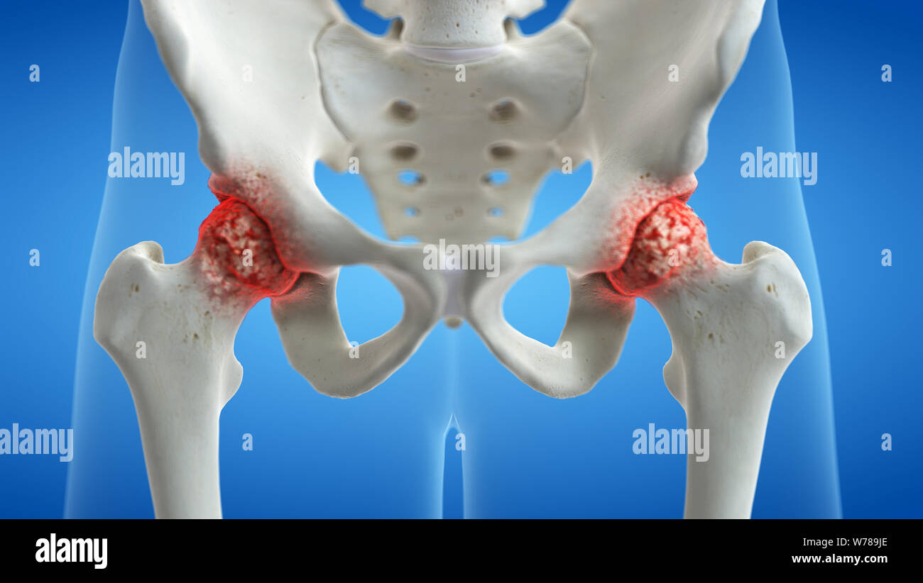 3d rendered medically accurate illustration of an arthritic hip joint