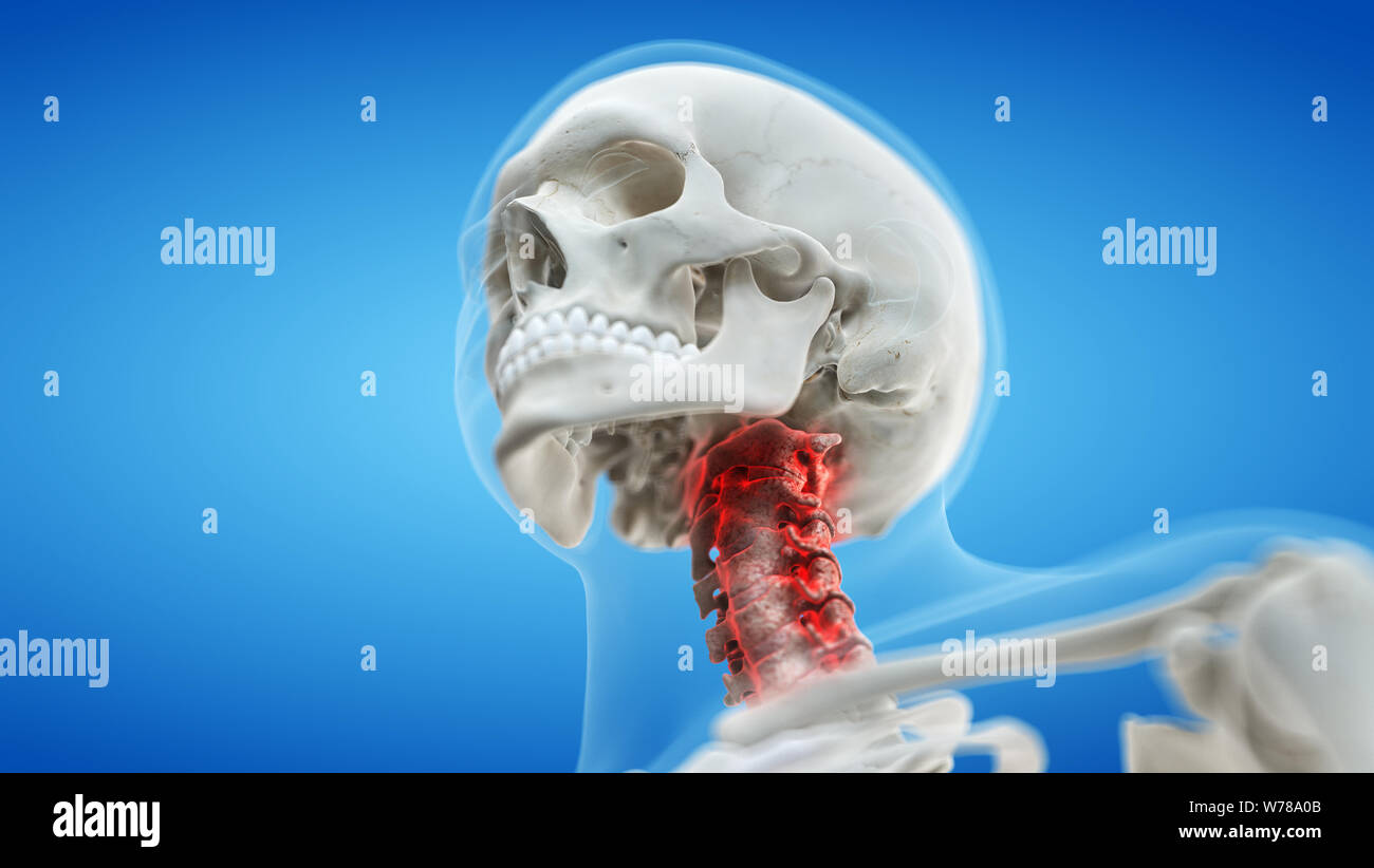3d rendered medically accurate illustration of an arthritic cervical