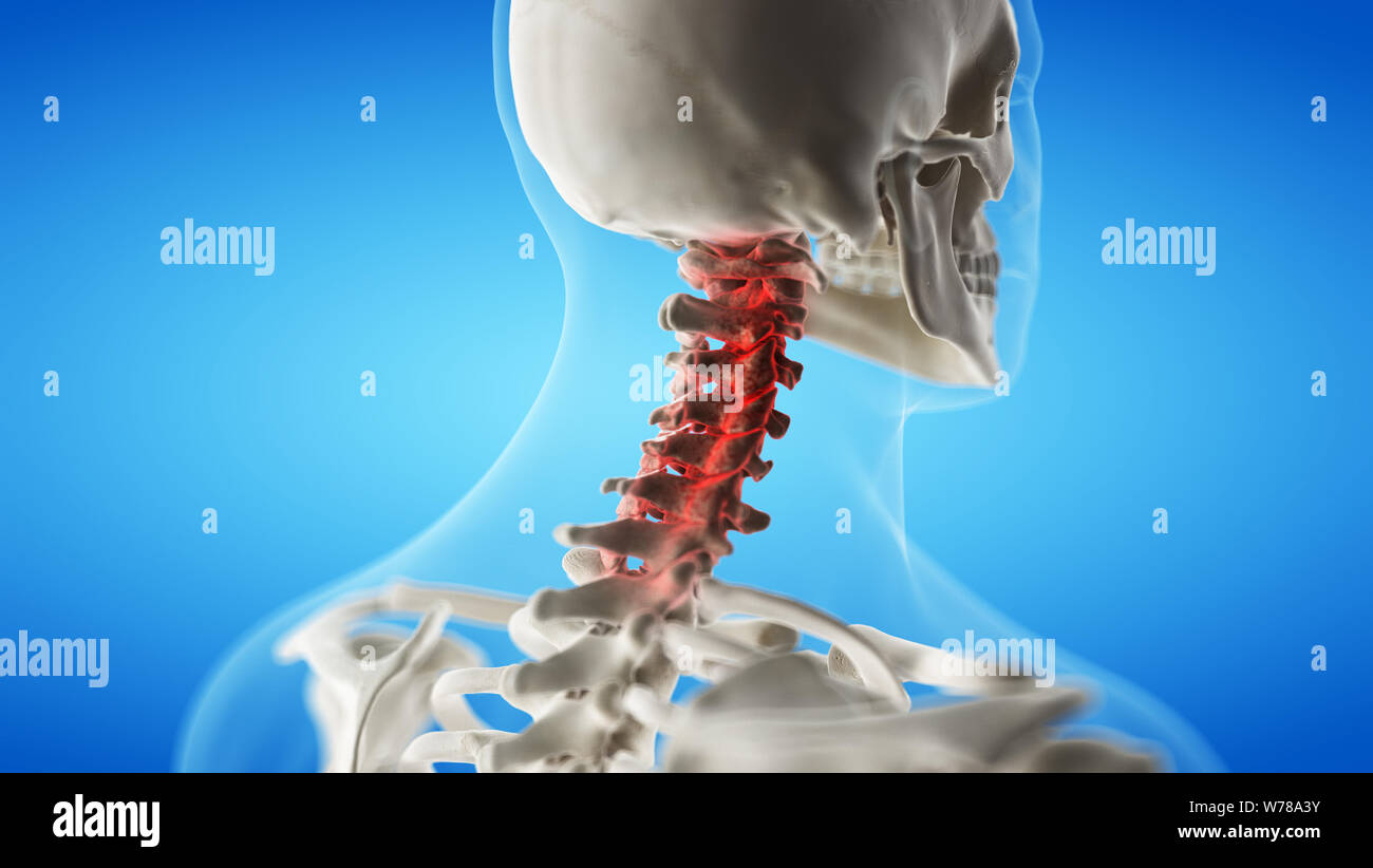 3d rendered medically accurate illustration of an arthritic cervical