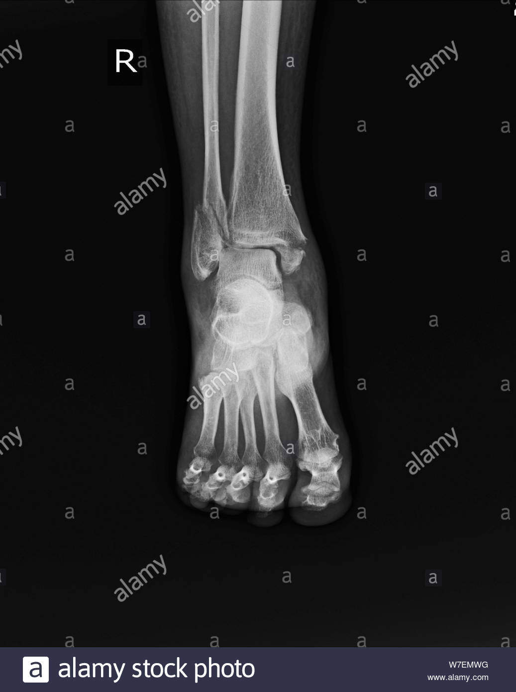 tibial spiral fracture