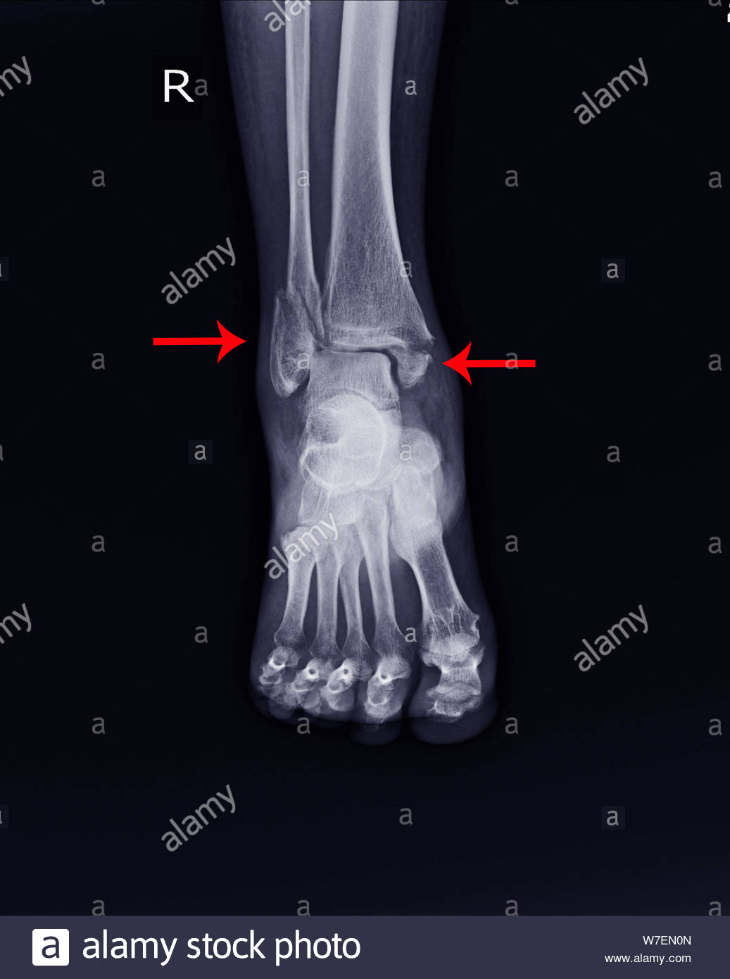 spiral fracture of tibia and fibula recovery time spiral fracture of tibia and fibula recovery time