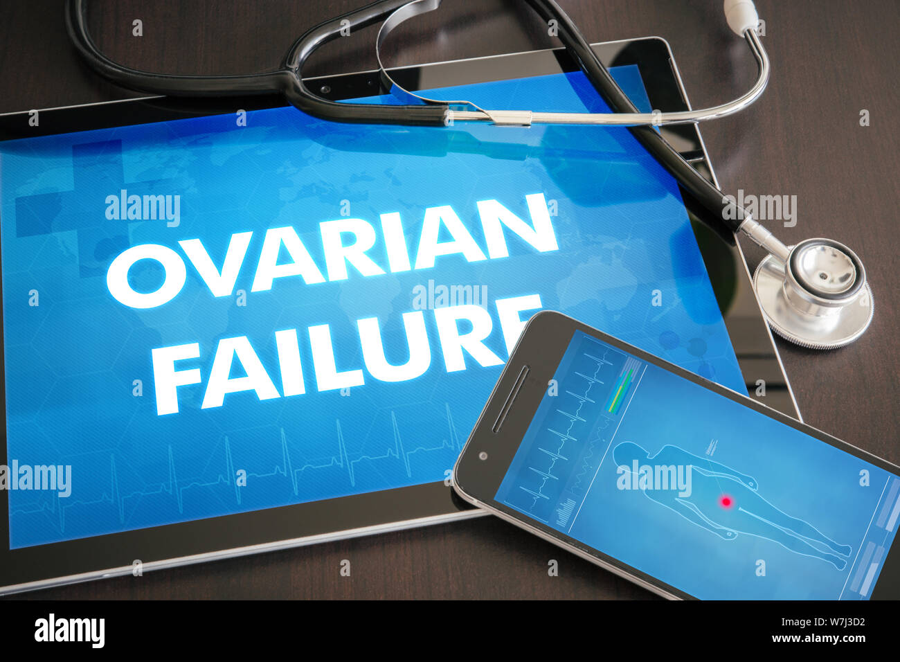 Ovarian failure (endocrine disease) diagnosis medical concept on tablet screen with stethoscope. Stock Photo