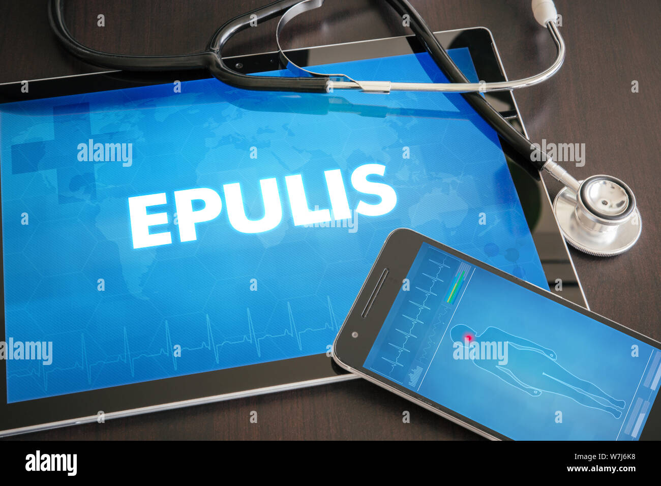 Epulis (cutaneous disease) diagnosis medical concept on tablet screen with stethoscope. Stock Photo