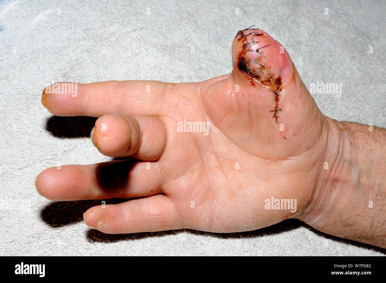Hand with damaged thumb as result of Cobra (Naja naja naja) bite, India, November 2012 Stock Photo