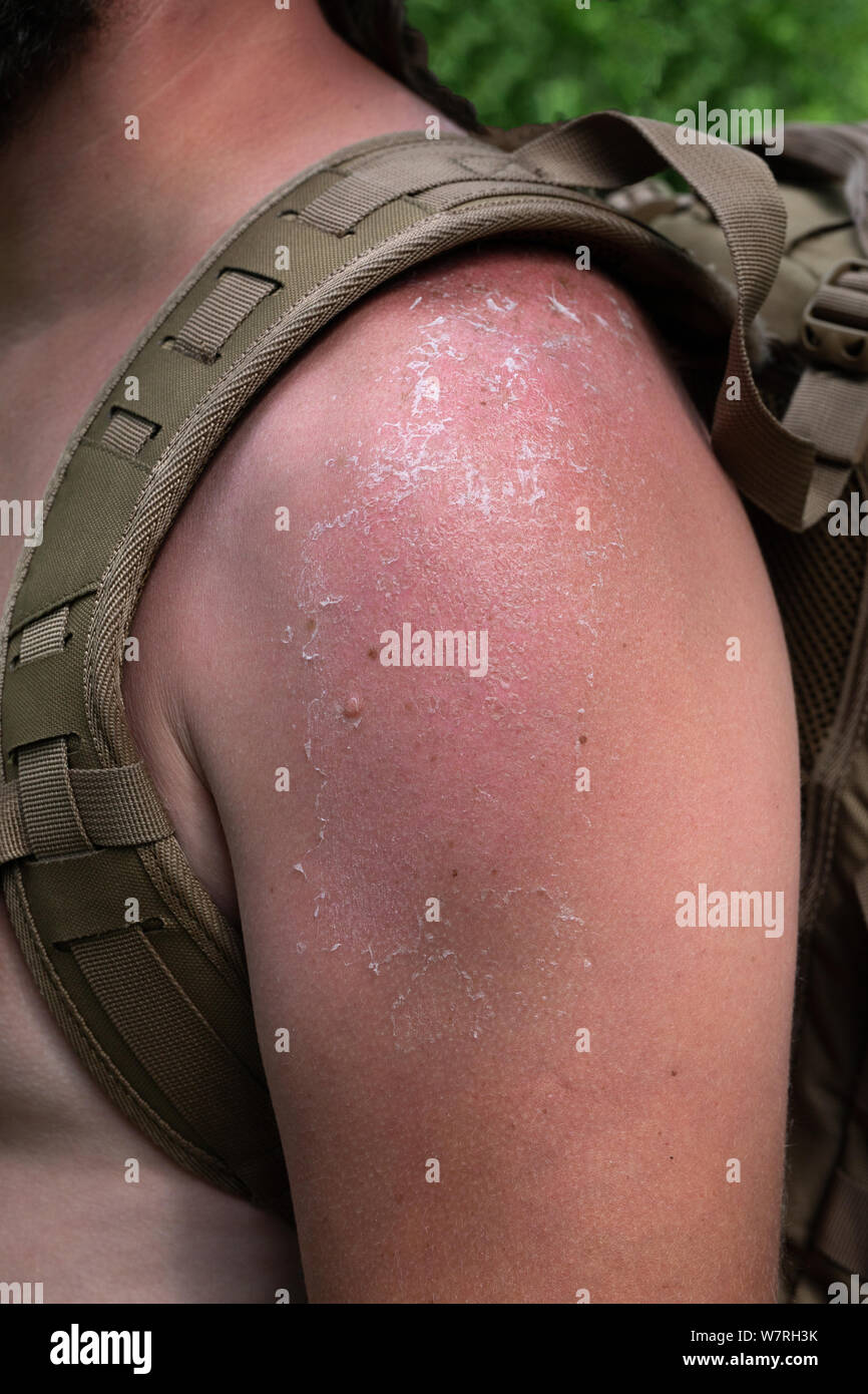 Sunburn of the skin on the shoulder. Reddened, flaky skin burned in the sun. Stock Photo