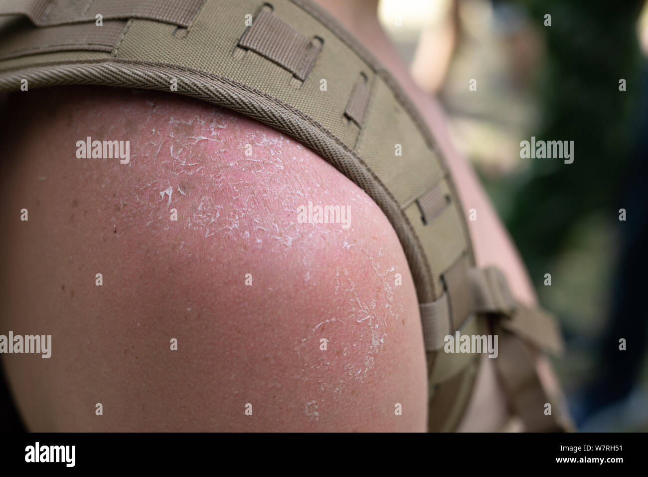 Sunburned shoulder with a backpack strap close-up. Sunburn of the skin. Stock Photo