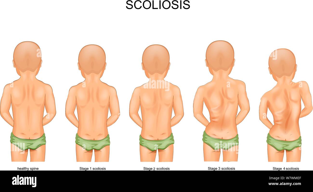 vector illustration of scoliosis stage in children Stock Vector