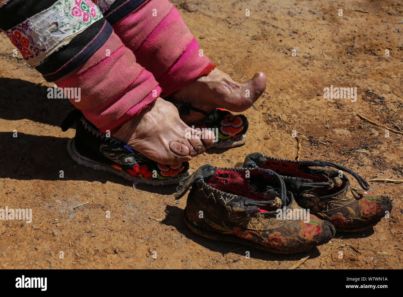 Foot binding hi-res stock photography and images - Alamy