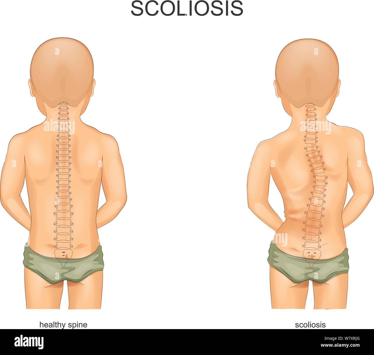 vector illustration of scoliosis stage in children Stock Vector