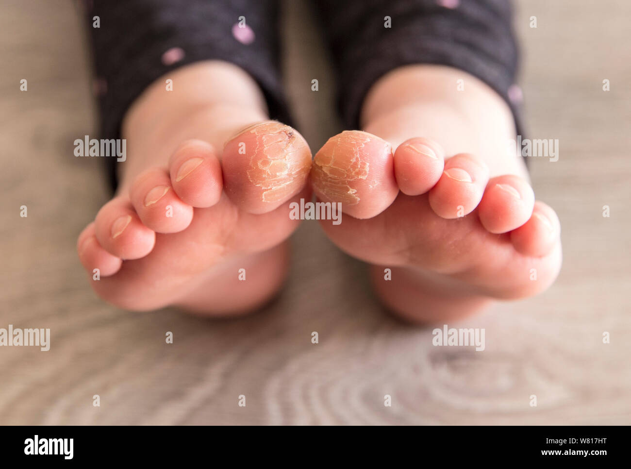 Close-up view of 4 year old child girl with cracks on her big toes. Bad skin condition concept. Stock Photo