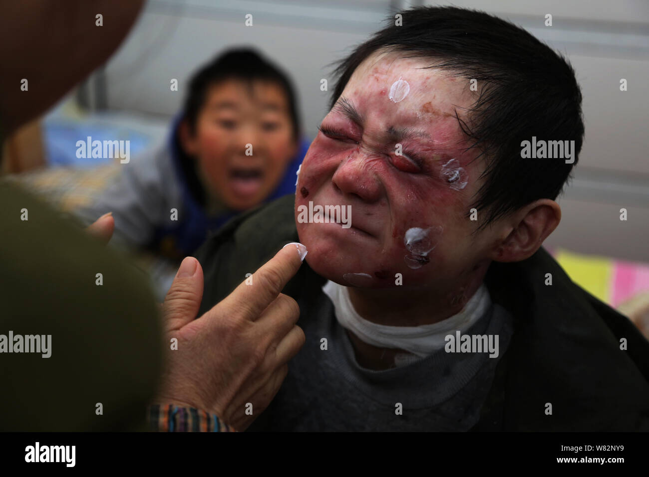 19-year-old Chinese boy Mei Xiao, dubbed the 'butterfly boy', who suffers  from a genetic skin illness, is pictured at home in Chizhou city, east  China Stock Photo - Alamy