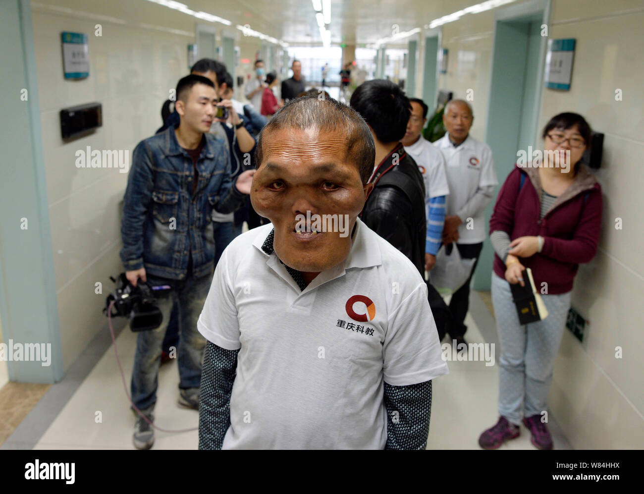 Chinese villager Xia Yuanhai, center, who has an alien-like deformed face, is pictured at Chongqing Xinqiao Hospital in Chongqing, China, 25 October 2 Stock Photo