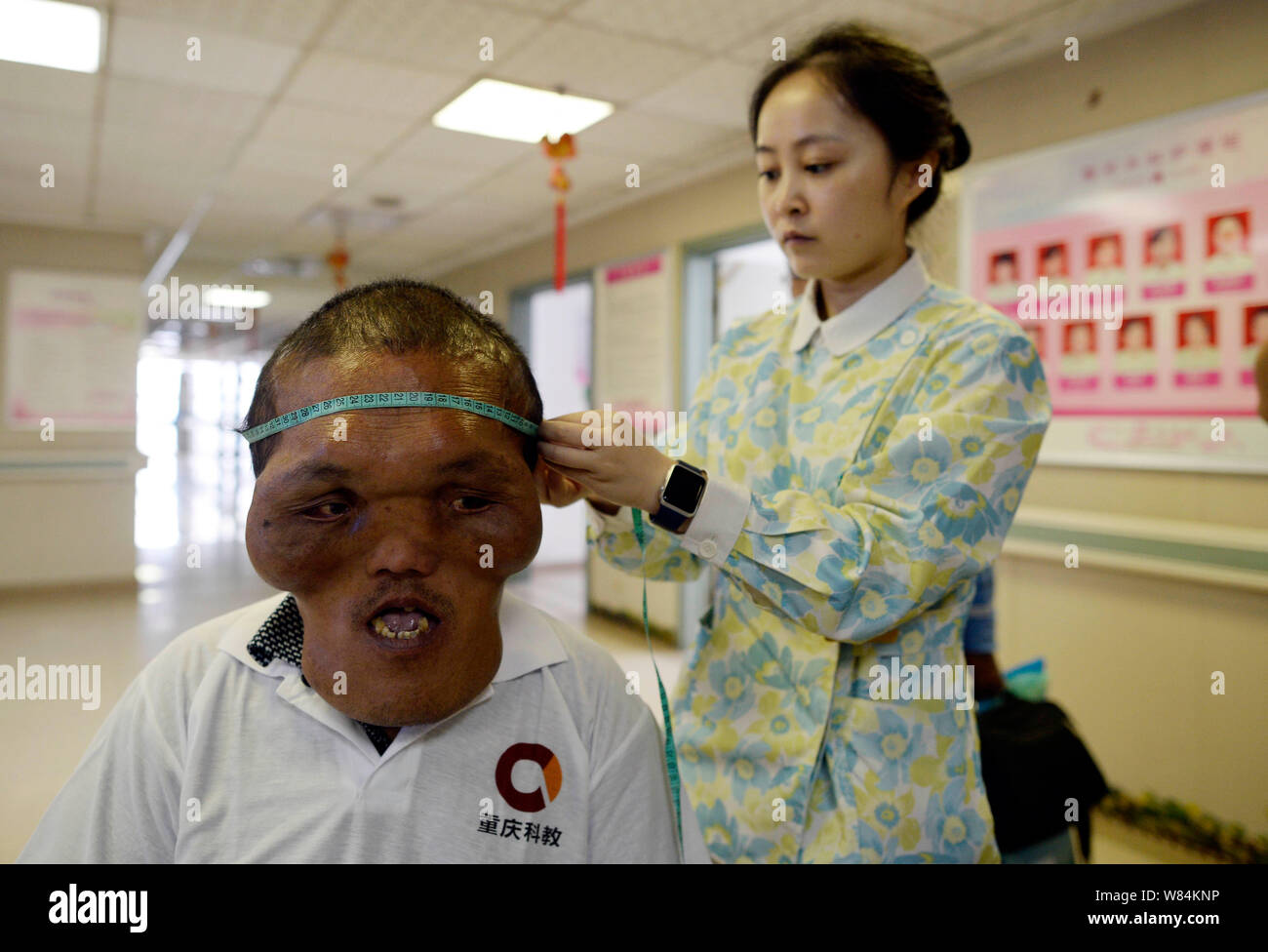 Chinese villager Xia Yuanhai who has an alien-like deformed face is being checked at Chongqing Xinqiao Hospital in Chongqing, China, 25 October 2016. Stock Photo
