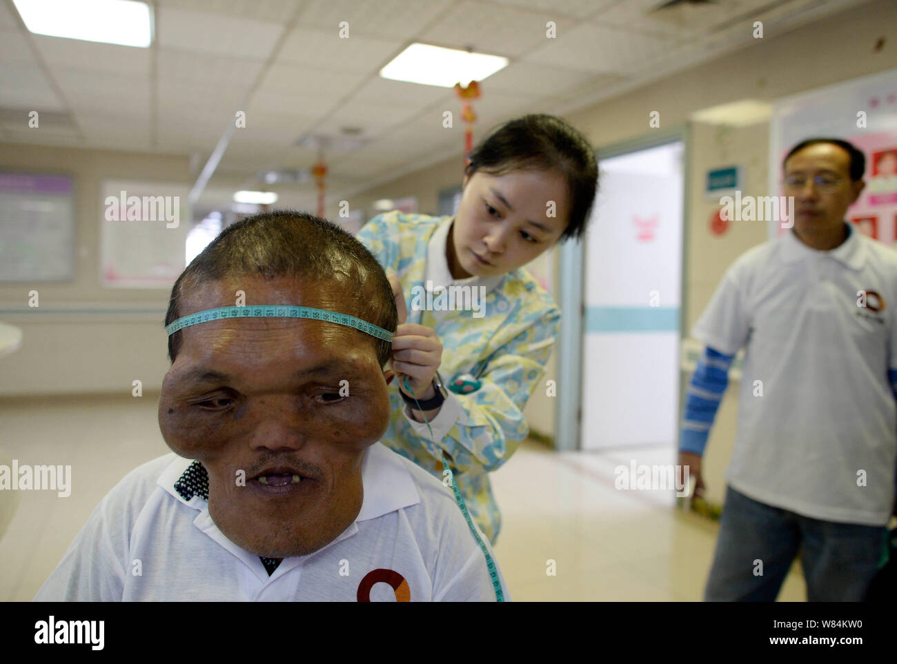 Chinese villager Xia Yuanhai who has an alien-like deformed face is being checked at Chongqing Xinqiao Hospital in Chongqing, China, 25 October 2016. Stock Photo