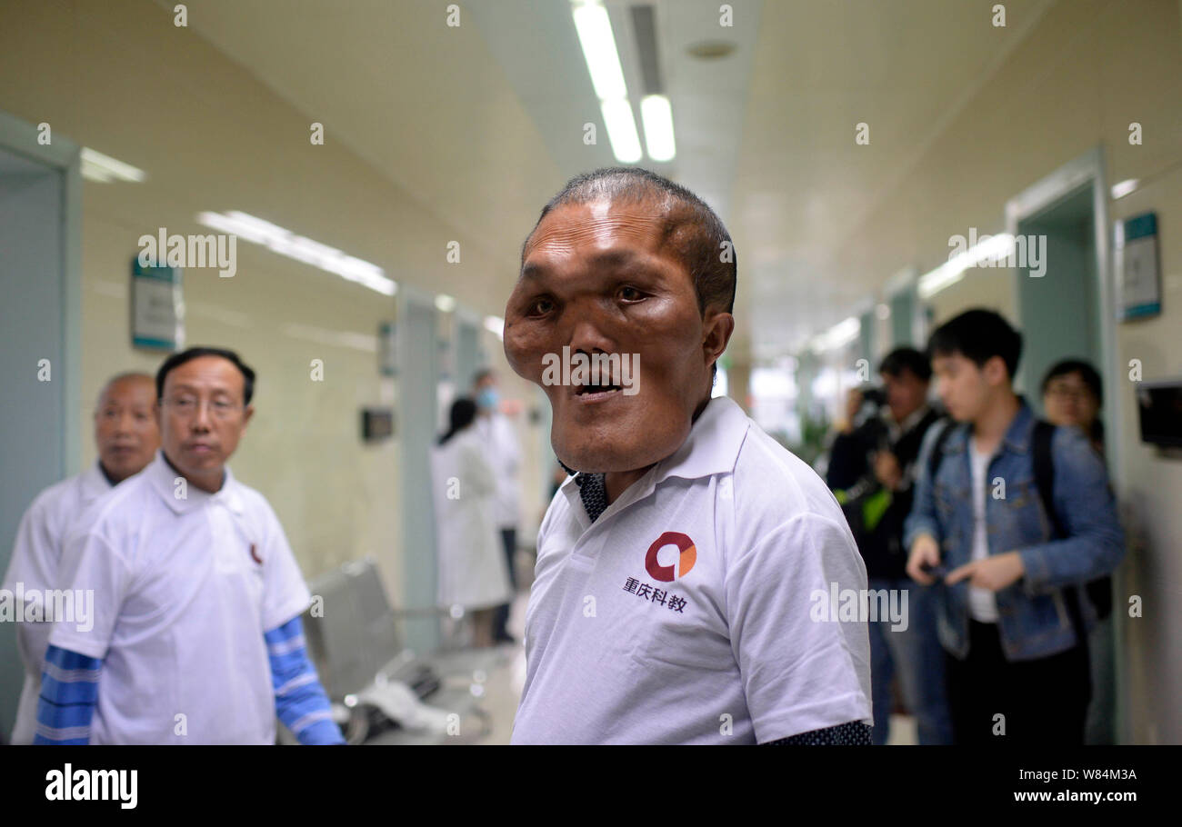 Chinese villager Xia Yuanhai, center, who has an alien-like deformed face, is pictured at Chongqing Xinqiao Hospital in Chongqing, China, 25 October 2 Stock Photo