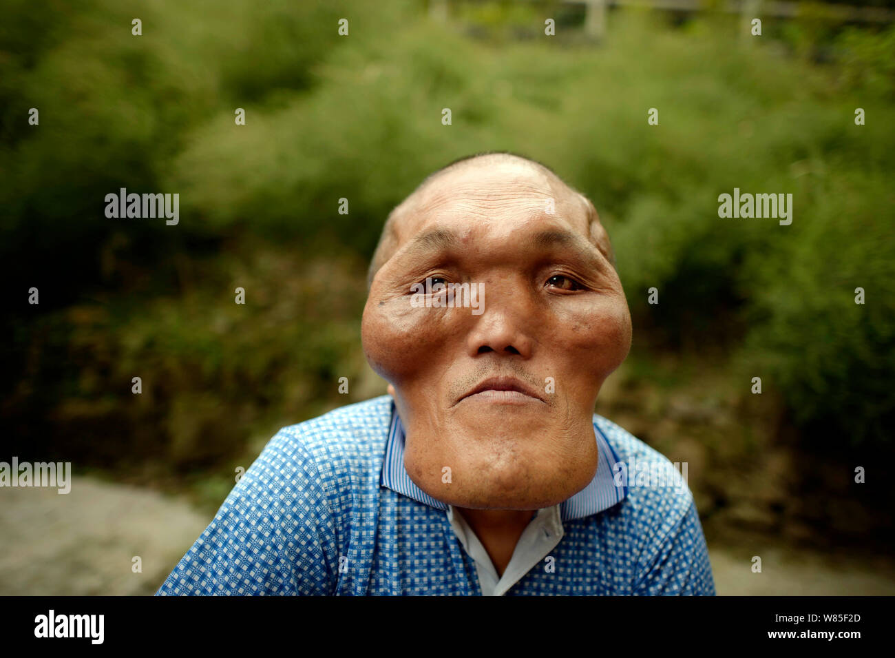 Chinese villager Xia Yuanhai who has an alien-like deformed face poses for photos at home in Laotu village, Changling town, Chongqing, China, 23 Septe Stock Photo