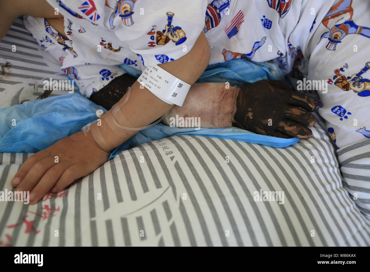 Nine-year-old boy Lei Lei is being treated at a hospital after his mother slashed his wrist with a meat cleaver to treat his snake bite in Chongqing, Stock Photo
