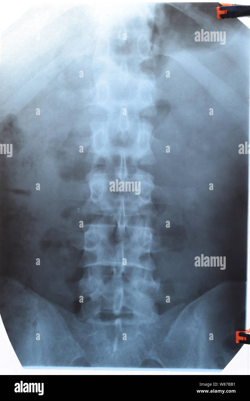 Xray of the lumbar spine hi-res stock photography and images - Alamy