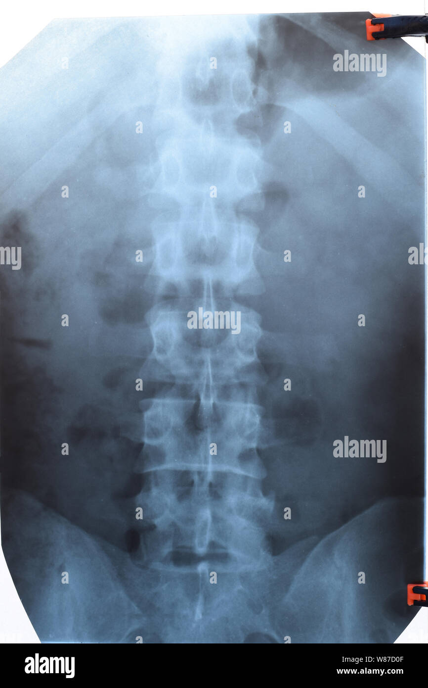 Xray of the lumbar spine, spine on xray Stock Photo Alamy