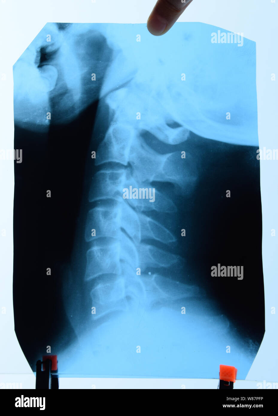 X-ray of the cervical vertebrae. X-ray image of the cervical spine. Stock Photo